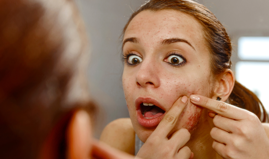 Dolci e brufoli: c'è davvero una correlazione?