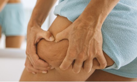 Ritenzione idrica estiva: cosa la peggiora e cosa aiuta davvero