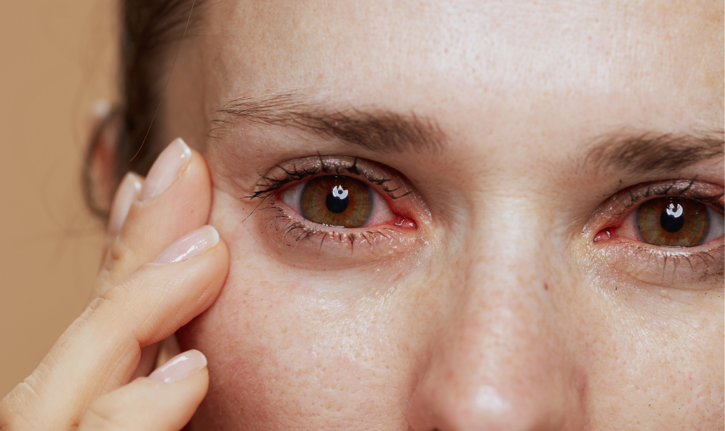 Occhi rossi e congiuntivite allergica
